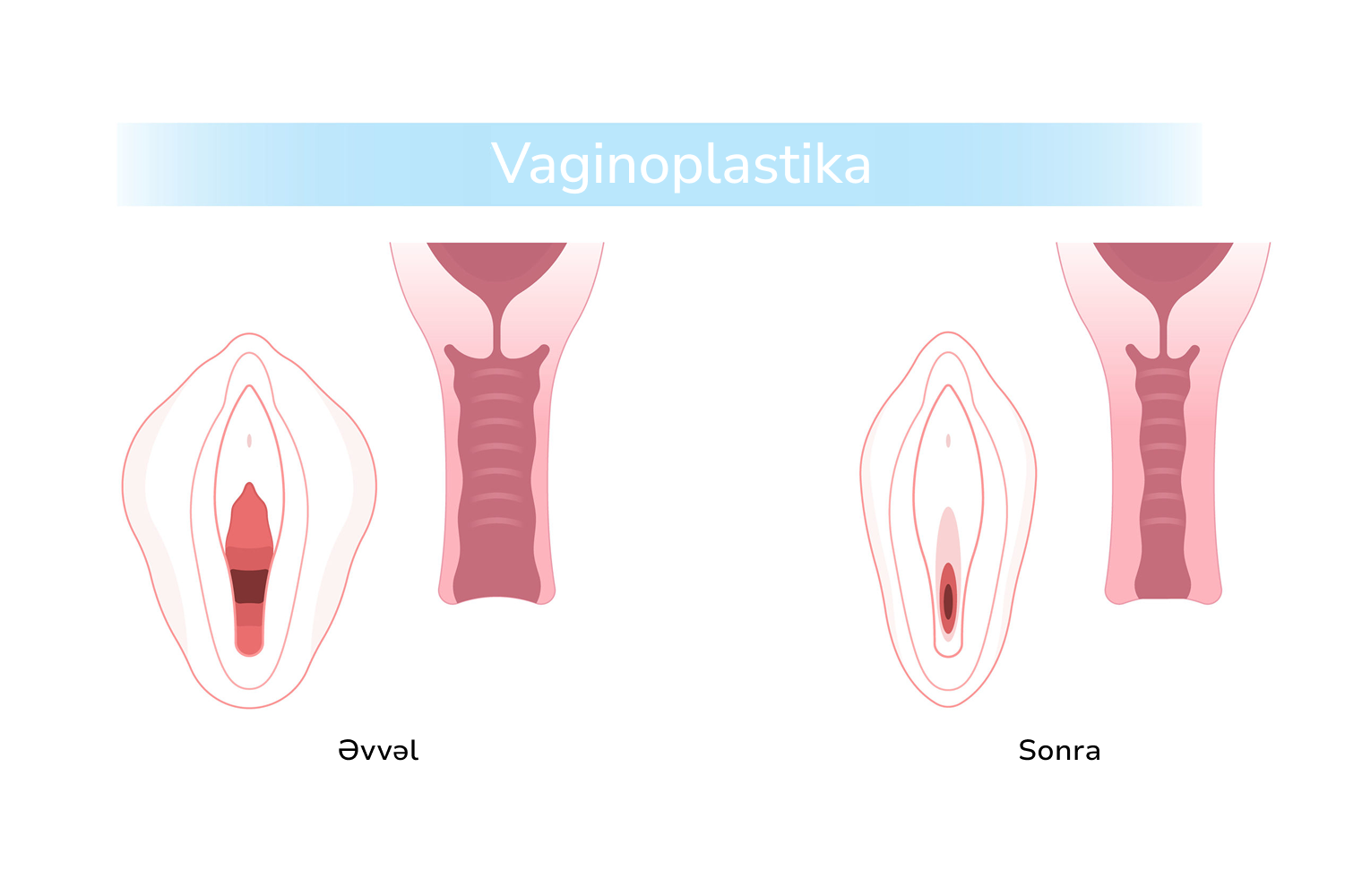 vaginoplastika 1